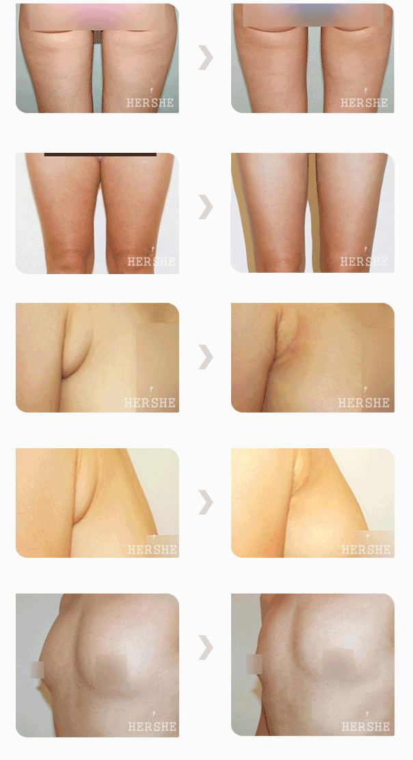breast