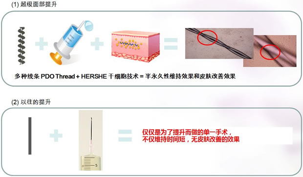 HERSHE 超级面部提升与以往的提升手术的差异