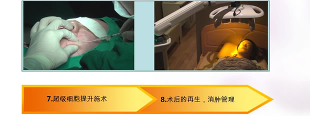 超级面部提升诊疗过程