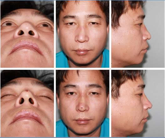 MISKO鼻整形前后对比照片