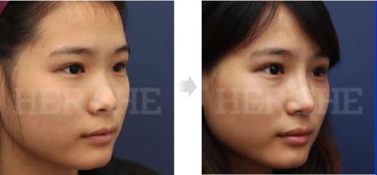 假体隆鼻整形术前后对比照片