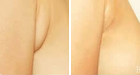 副乳切除手术前后对比照片